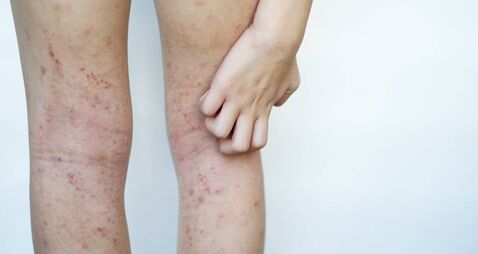 Allergy skin of an Asian kid on her legs with hand to scratch in natural light.